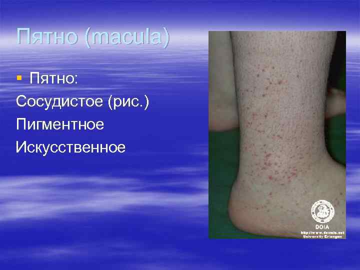Пятно (macula) § Пятно: Сосудистое (рис. ) Пигментное Искусственное Пятно (macula) § Пятно: Сосудистое (рис. ) Пигментное Искусственное