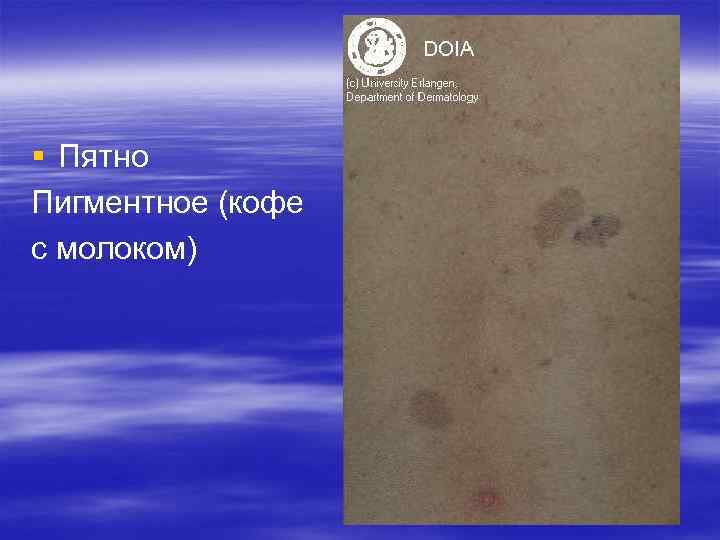 § Пятно Пигментное (кофе с молоком) § Пятно Пигментное (кофе с молоком)