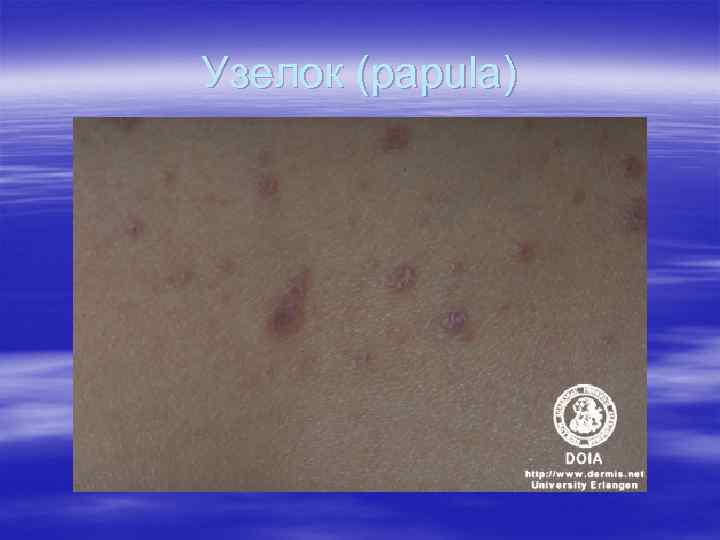 Узелок (papula) Узелок (papula)