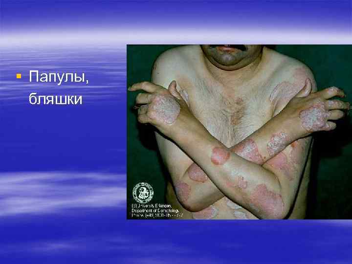 § Папулы, бляшки § Папулы, бляшки