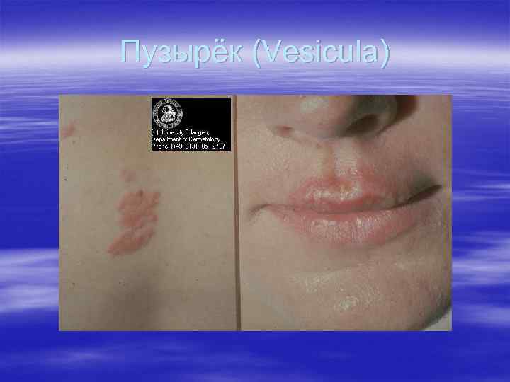 Пузырёк (Vesicula) Пузырёк (Vesicula)