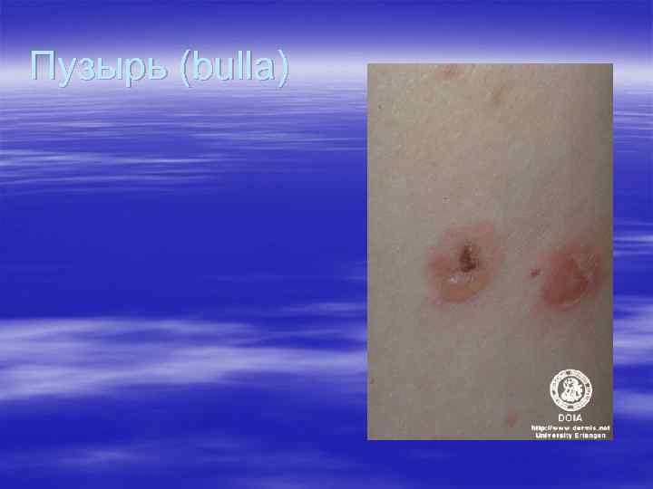 Пузырь (bulla) Пузырь (bulla)