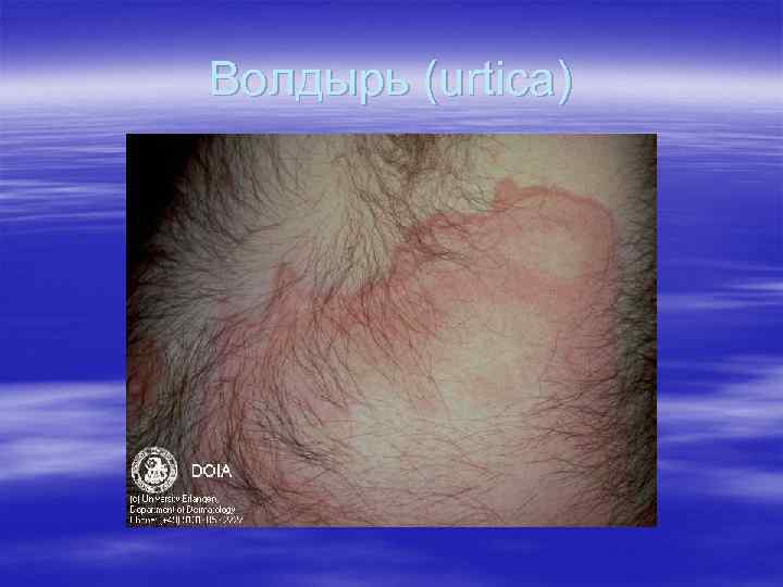 Волдырь (urtica) Волдырь (urtica)
