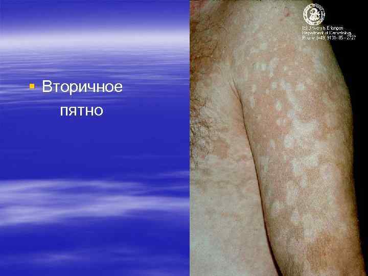 § Вторичное пятно § Вторичное пятно