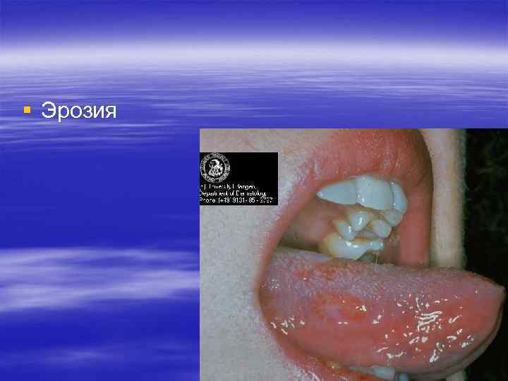 § Эрозия § Эрозия