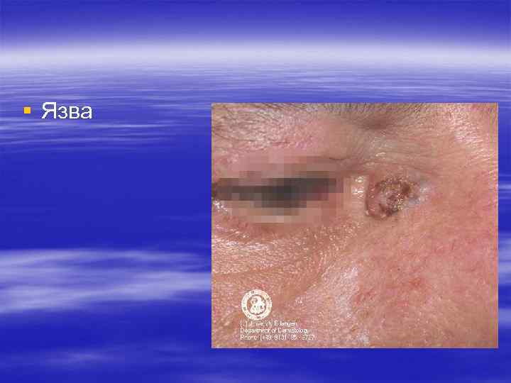 § Язва § Язва