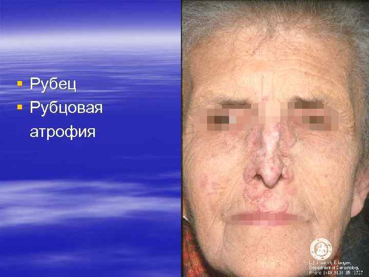 § Рубец § Рубцовая атрофия § Рубец § Рубцовая атрофия