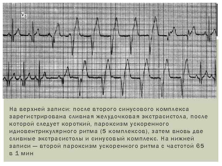 На верхней записи: после второго синусового комплекса зарегистрирована сливная желудочковая экстрасистола, после которой следует