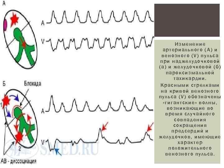   Изменение  артериального (А) и венозного (V) пульса при наджелудочковой (а) и