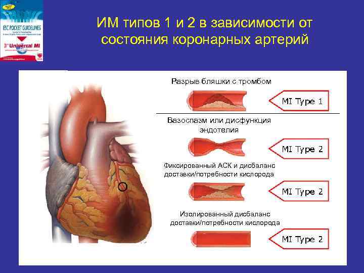 ИМ типов 1 и 2 в зависимости от состояния коронарных артерий   Разрыв