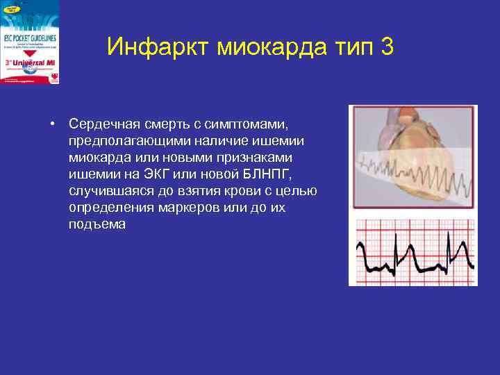   Инфаркт миокарда тип 3  • Сердечная смерть с симптомами,  предполагающими