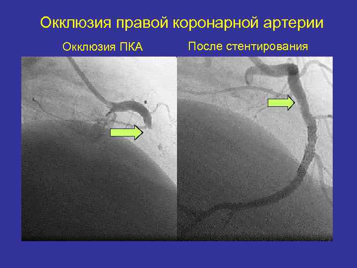 Окклюзия правой коронарной артерии  Окклюзия ПКА  После стентирования 