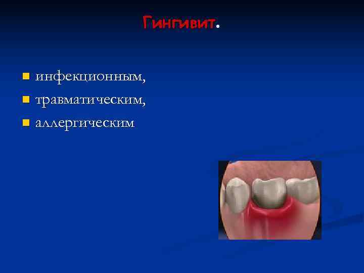     Гингивит.  n инфекционным, n травматическим,  n аллергическим 