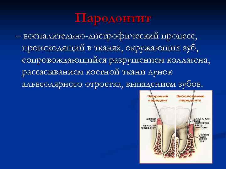   Пародонтит – воспалительно-дистрофический процесс,  происходящий в тканях, окружающих зуб,  сопровождающийся