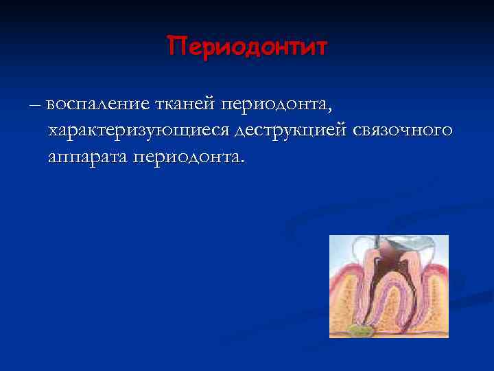    Периодонтит – воспаление тканей периодонта,  характеризующиеся деструкцией связочного  аппарата