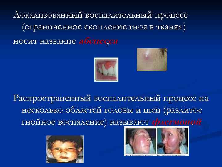Локализованный воспалительный процесс  (ограниченное скопление гноя в тканях) носит название абсцесса  