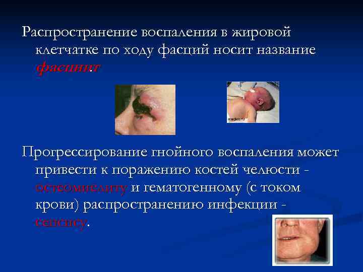 Распространение воспаления в жировой  клетчатке по ходу фасций носит название  фасциит. Прогрессирование