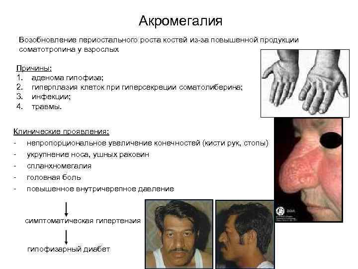 Акромегалия симптомы фото