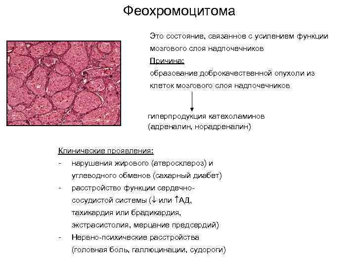 Феохромоцитома презентация по эндокринологии