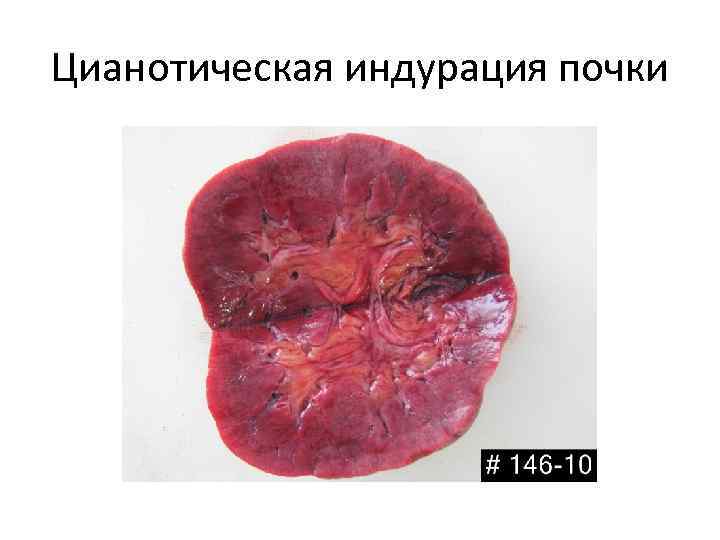 Цианотическая индурация почки 