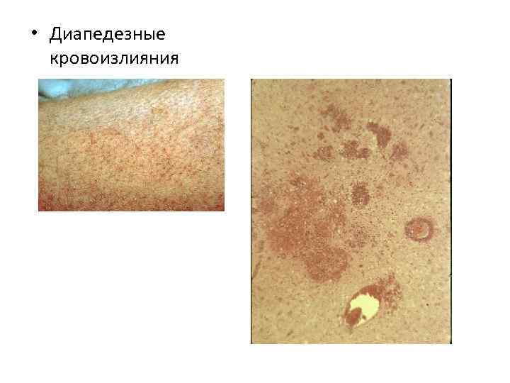  • Диапедезные  кровоизлияния 