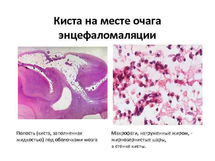    Киста на месте очага   энцефаломаляции Полость (киста, заполненная 