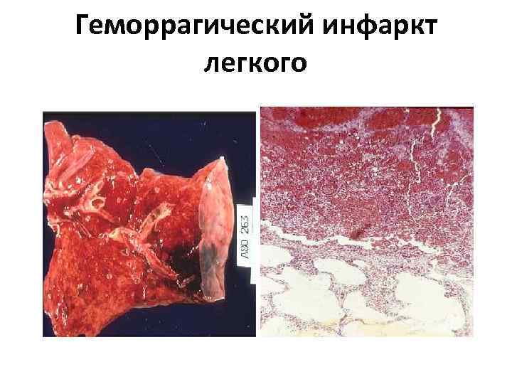 Геморрагический инфаркт   легкого 