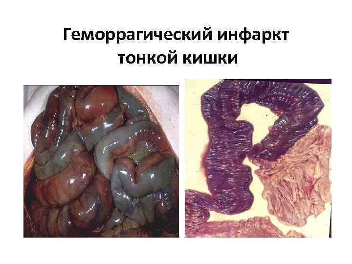 Геморрагический инфаркт  тонкой кишки 