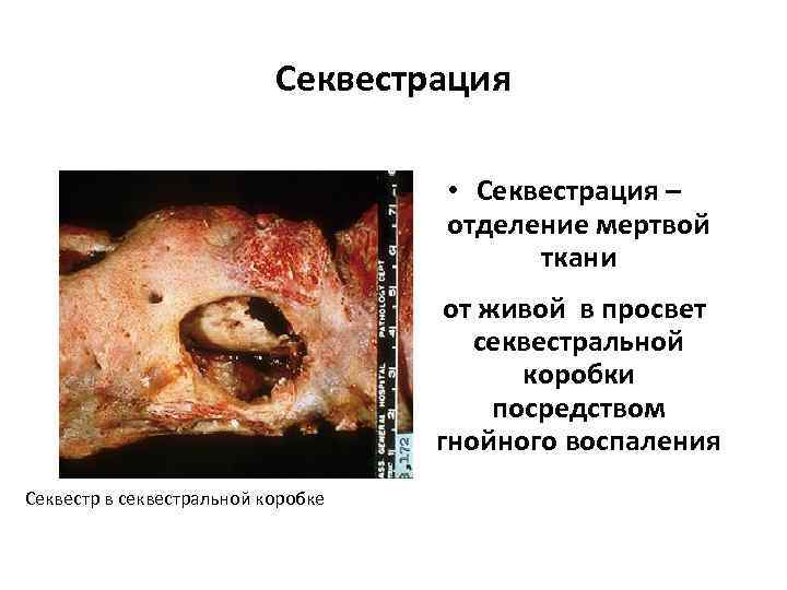       Секвестрация    • Секвестрация – 