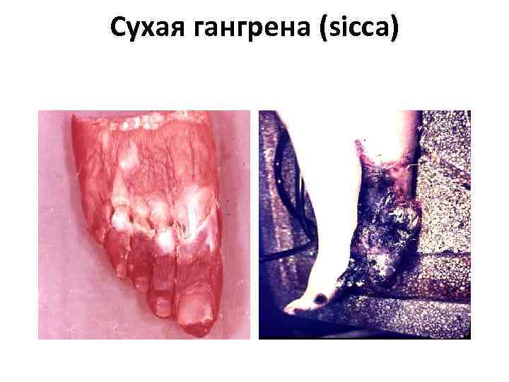 Сухая гангрена (sicca) 