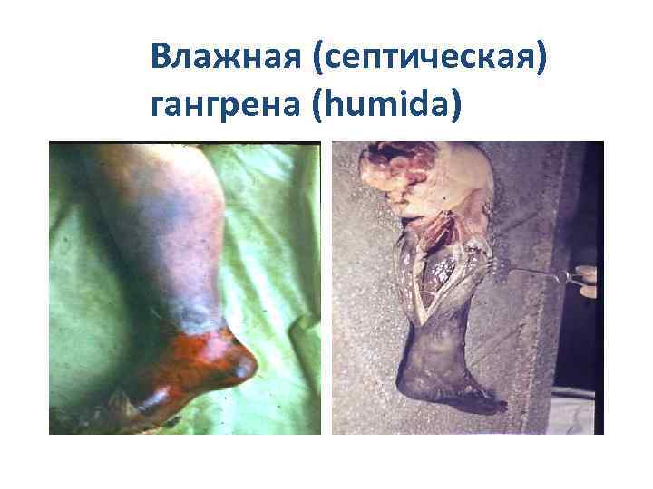     Влажная (септическая)   гангрена (humida)    