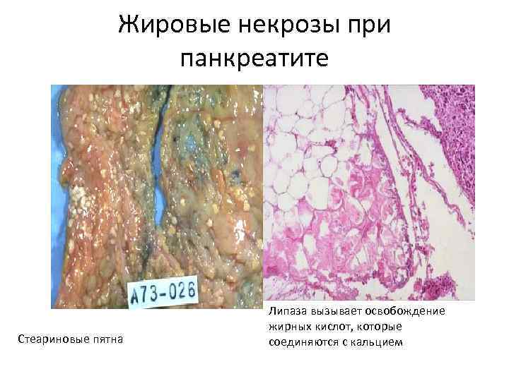     Жировые некрозы при     панкреатите  