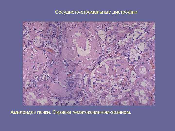    Сосудисто-стромальные дистрофии Амилоидоз почки. Окраска гематоксилином-эозином. 