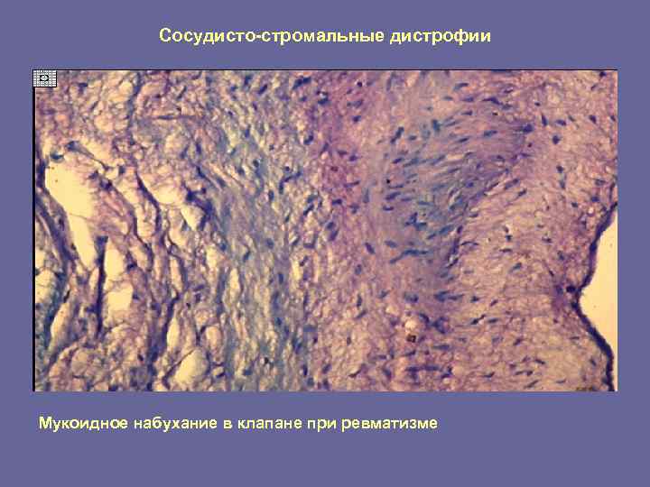   Сосудисто-стромальные дистрофии Мукоидное набухание в клапане при ревматизме 