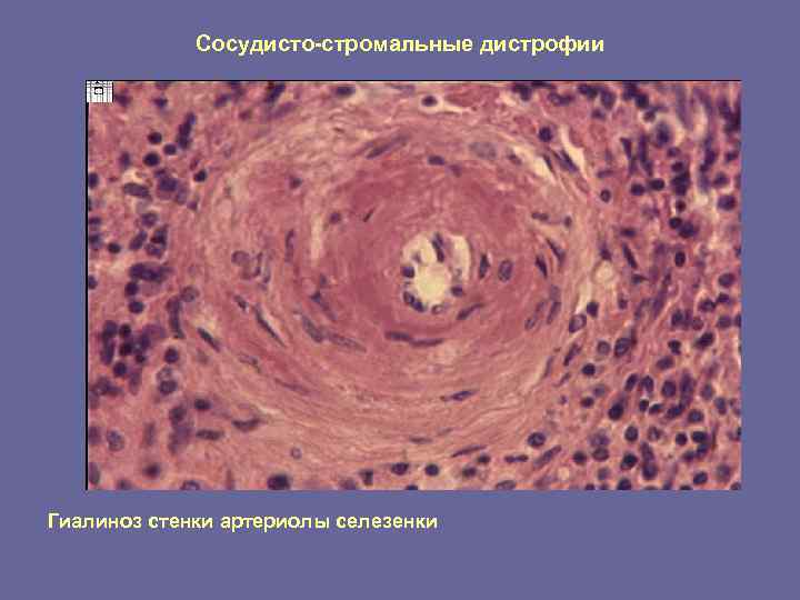    Сосудисто-стромальные дистрофии Гиалиноз стенки артериолы селезенки 