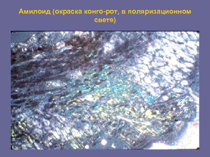 Амилоид (окраска конго-рот, в поляризационном     свете) 