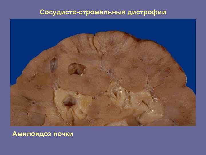  Сосудисто-стромальные дистрофии Амилоидоз почки 