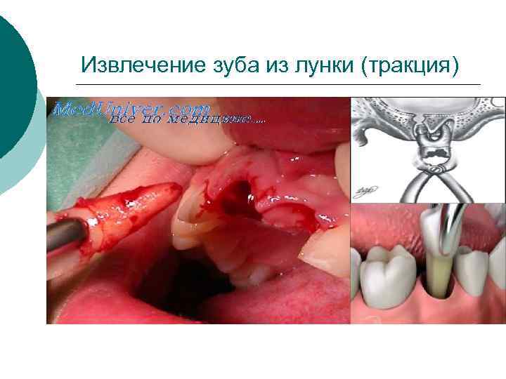 Извлечение зуба из лунки (тракция) 