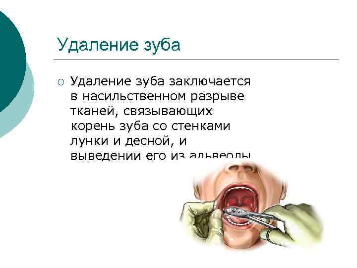 Удаление зуба ¡  Удаление зуба заключается в насильственном разрыве тканей, связывающих корень зуба