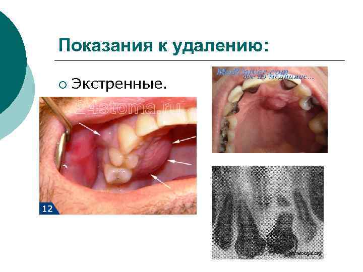 Показания к удалению:  ¡  Экстренные. 