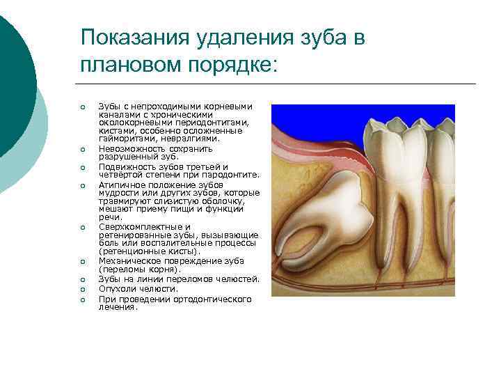 Показания удаления зуба в плановом порядке: ¡  Зубы с непроходимыми корневыми каналами с
