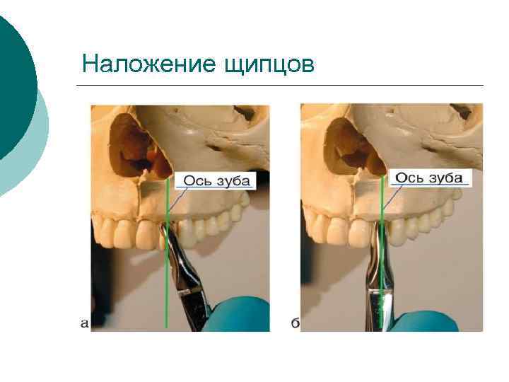 Удалении форум. Зуба накладываются щипцы. Наложение щипцов на зуб хирургия. Наложение щёчек щипцов на зуб.