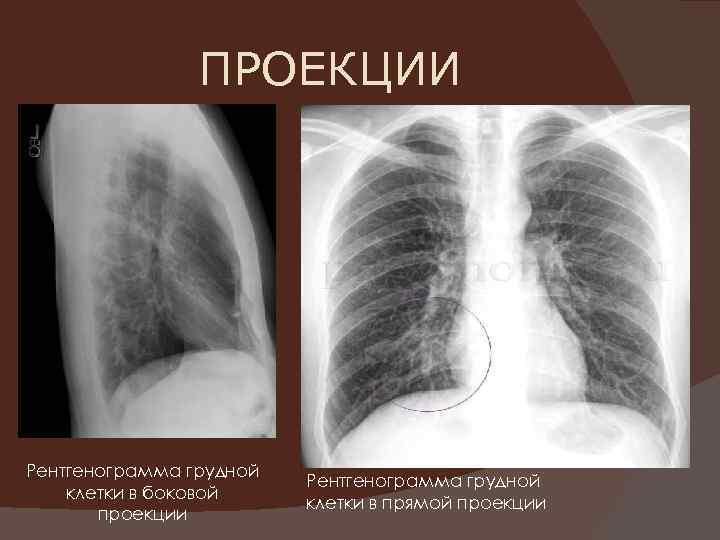     ПРОЕКЦИИ Рентгенограмма грудной     Рентгенограмма грудной клетки