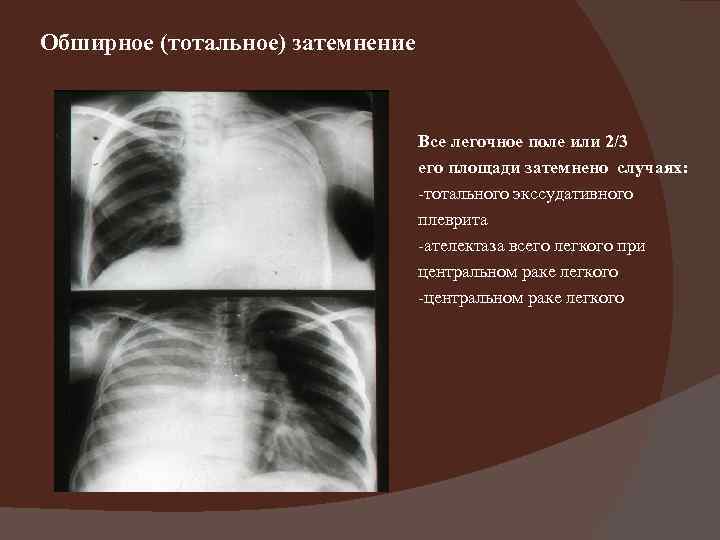 Обширное (тотальное) затемнение       Все легочное поле или 2/3