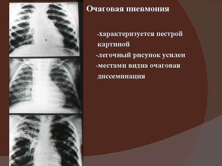 Очаговая пневмония  -характеризуется  пестрой  картиной  -легочный рисунок усилен  -местами