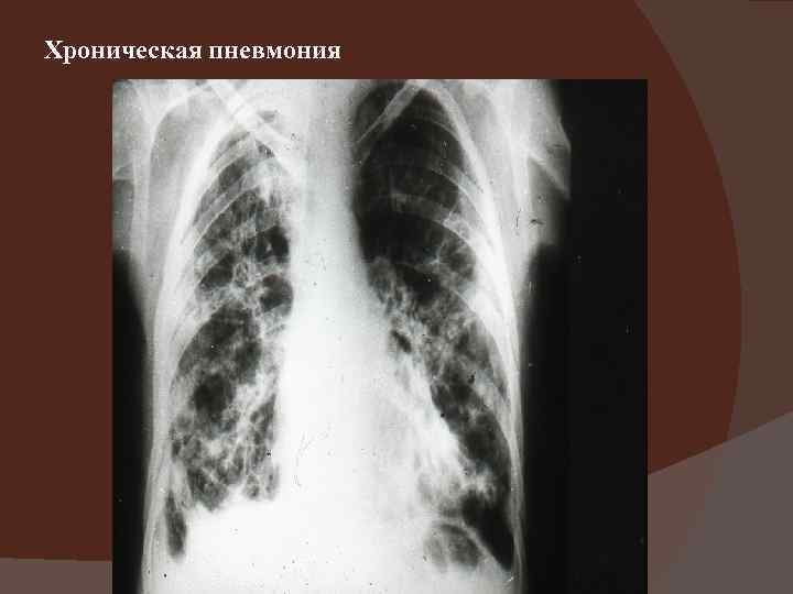 Хроническая пневмония 