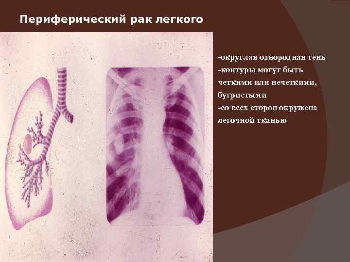 Периферический рак легкого      -округлая однородная тень   