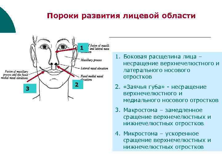 Пороки развития лицевой области 1 1. Боковая расщелина лица – несращение верхнечелюстного и латерального