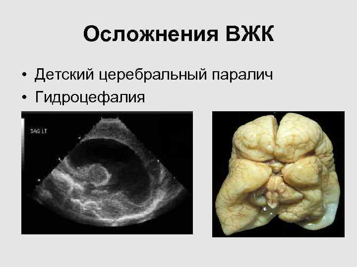 Осложнения ВЖК • Детский церебральный паралич • Гидроцефалия Осложнения ВЖК • Детский церебральный паралич • Гидроцефалия