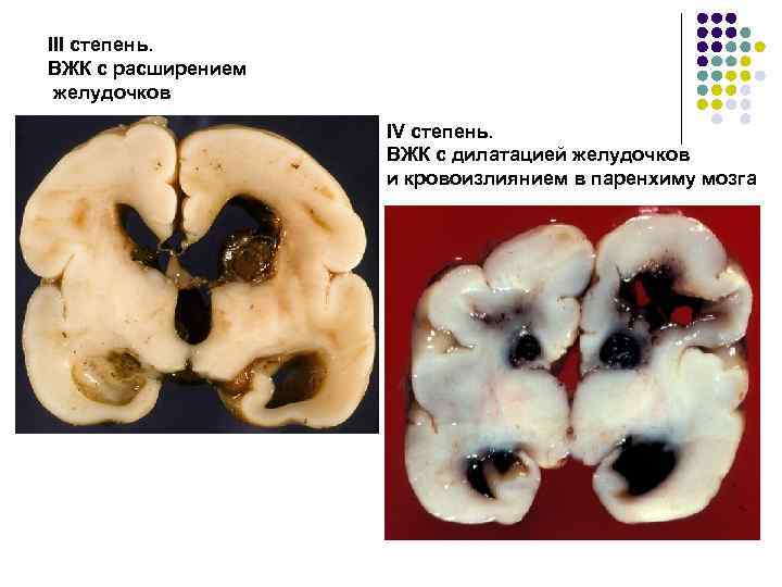 III степень. ВЖК с расширением желудочков IV степень. III степень. ВЖК с расширением желудочков IV степень.